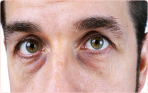 Eye Treatment at Integral Universe Wellness Clinic